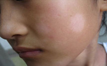 中老年人患上白癜风该怎么治