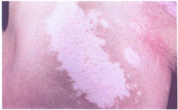 哪些因素会使白癜风加重