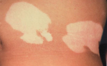 白癜风病因有哪些