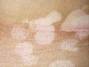 武汉治疗白颠环亚出彩 白癜风武汉环亚指定