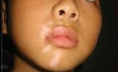 武汉治疗白巅环亚特约 武汉治疗白殿环亚特约