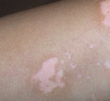 武汉白癫淀环亚 武汉白癫环亚