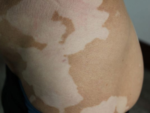 武汉医院治白环亚更优秀 武汉看白殿丰环亚